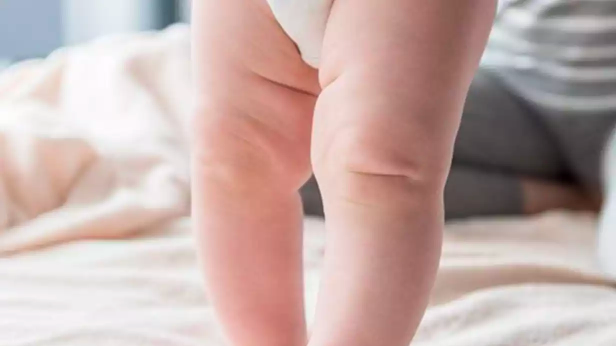 How is Leg Curvature (Bracketed Leg) Treated in Babies?