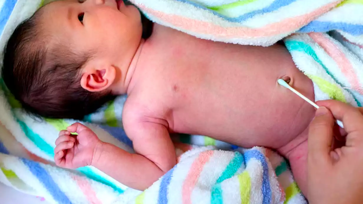 What Should You Do If Your Baby Has an Umbilical Hernia?